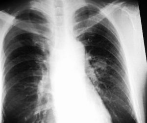 肺がんレントゲン画像
