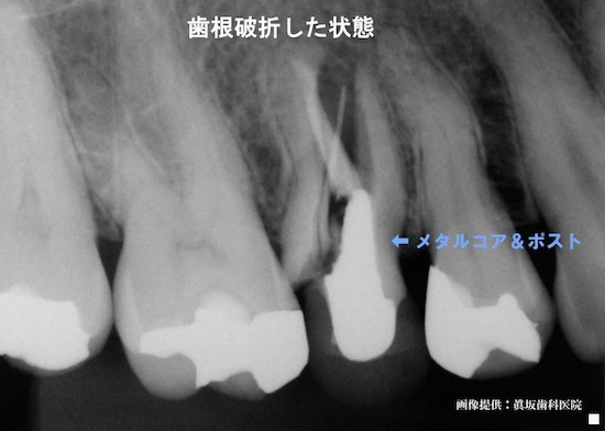 歯根破折した歯