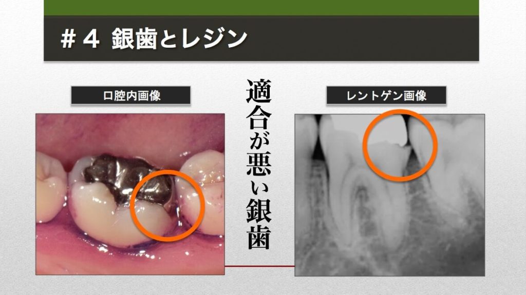 約１０年前に受けたという銀歯治療。不適合な銀歯の下では二次う蝕が進んでいた。隣の歯も倒れこんできている。（C）MICHIHIKO IWASAWA