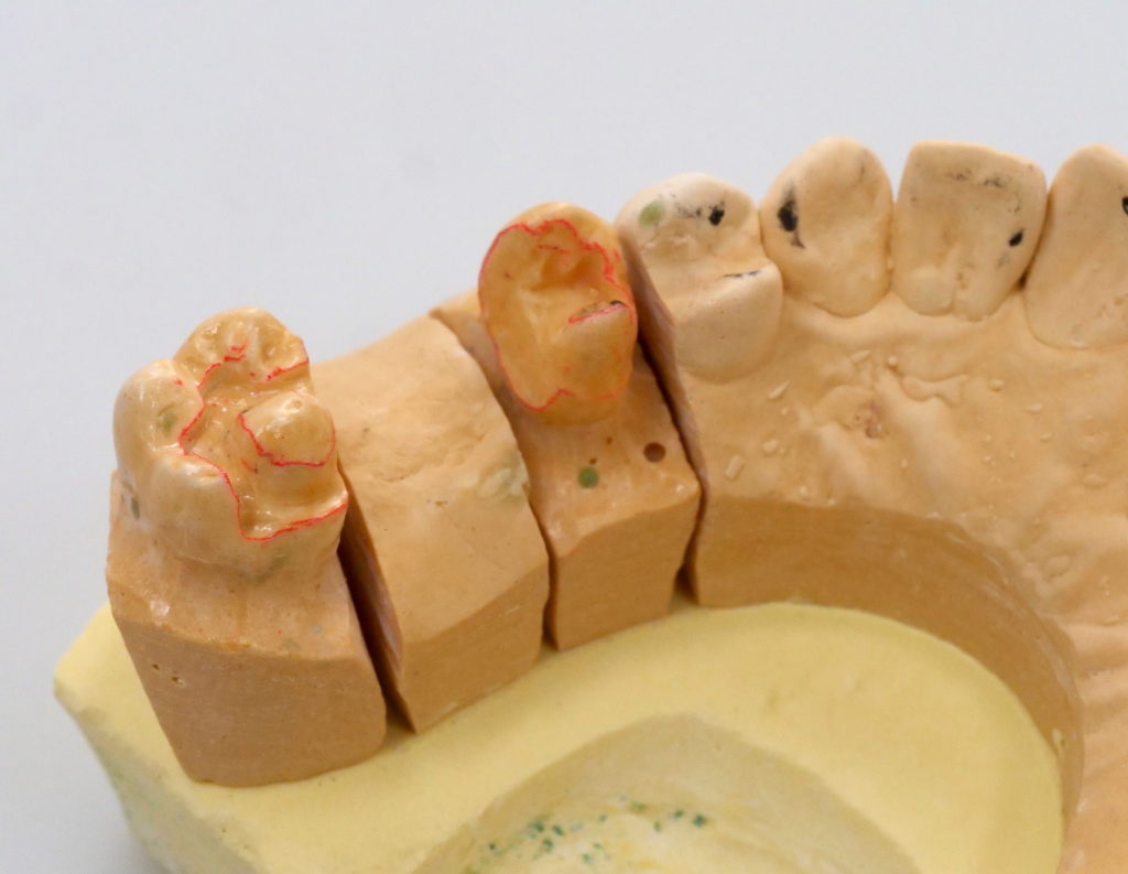 「接着ブリッジ」を製作するための模型 赤いライン部分が、歯のエナメル質を削った部分 （C）M.IWASAWA